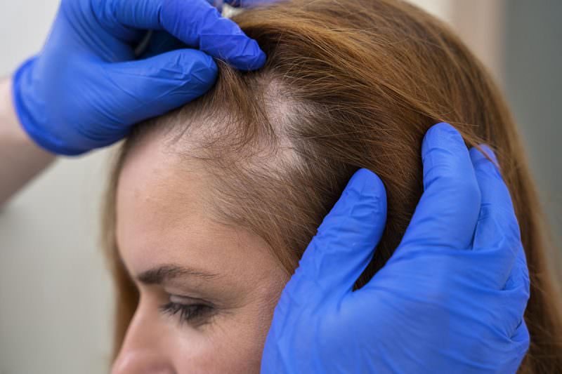 Alopecia Saiba Mais Sobre A Perda De Cabelos Que Afeta Mulheres